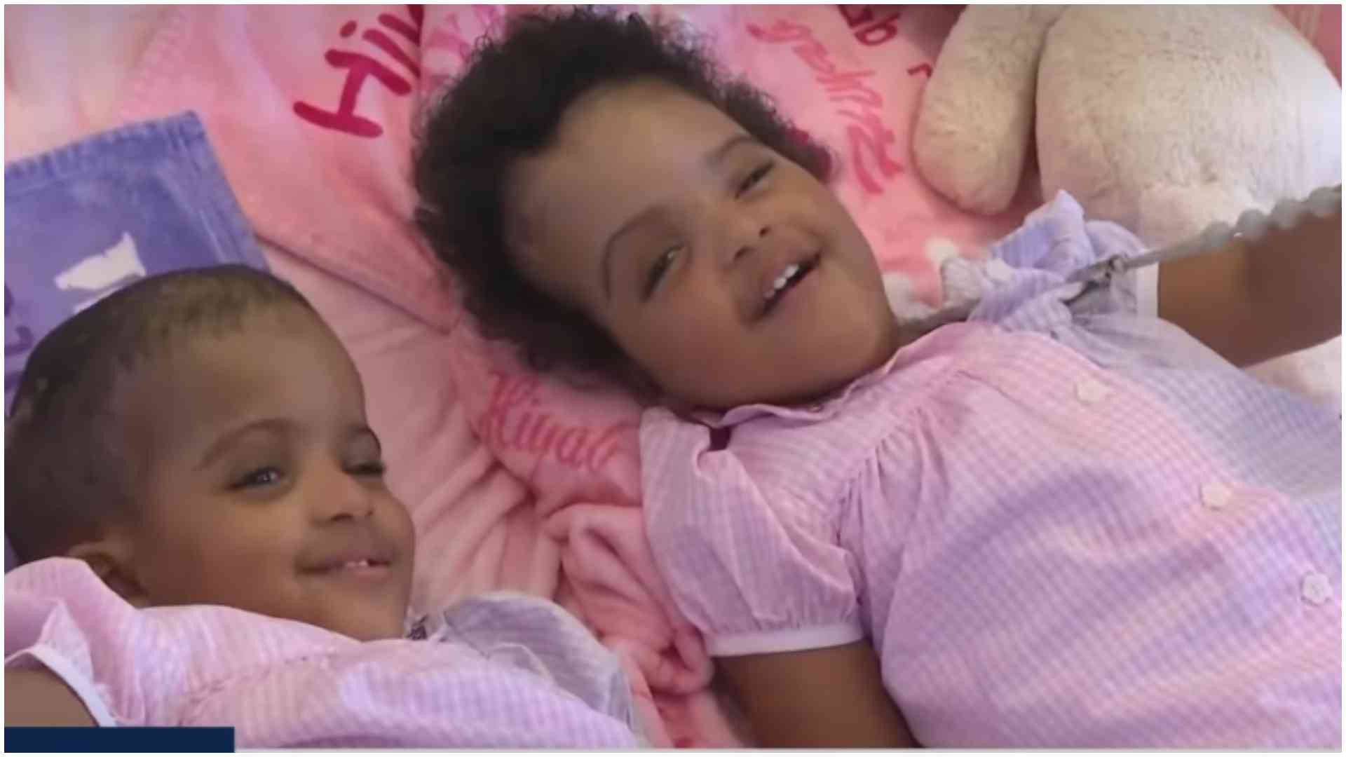 Ethiopian conjoined sisters see each other for first time after successful separation surgery in US Ethiopian conjoined sisters see each other for first time after successful separation surgery in US