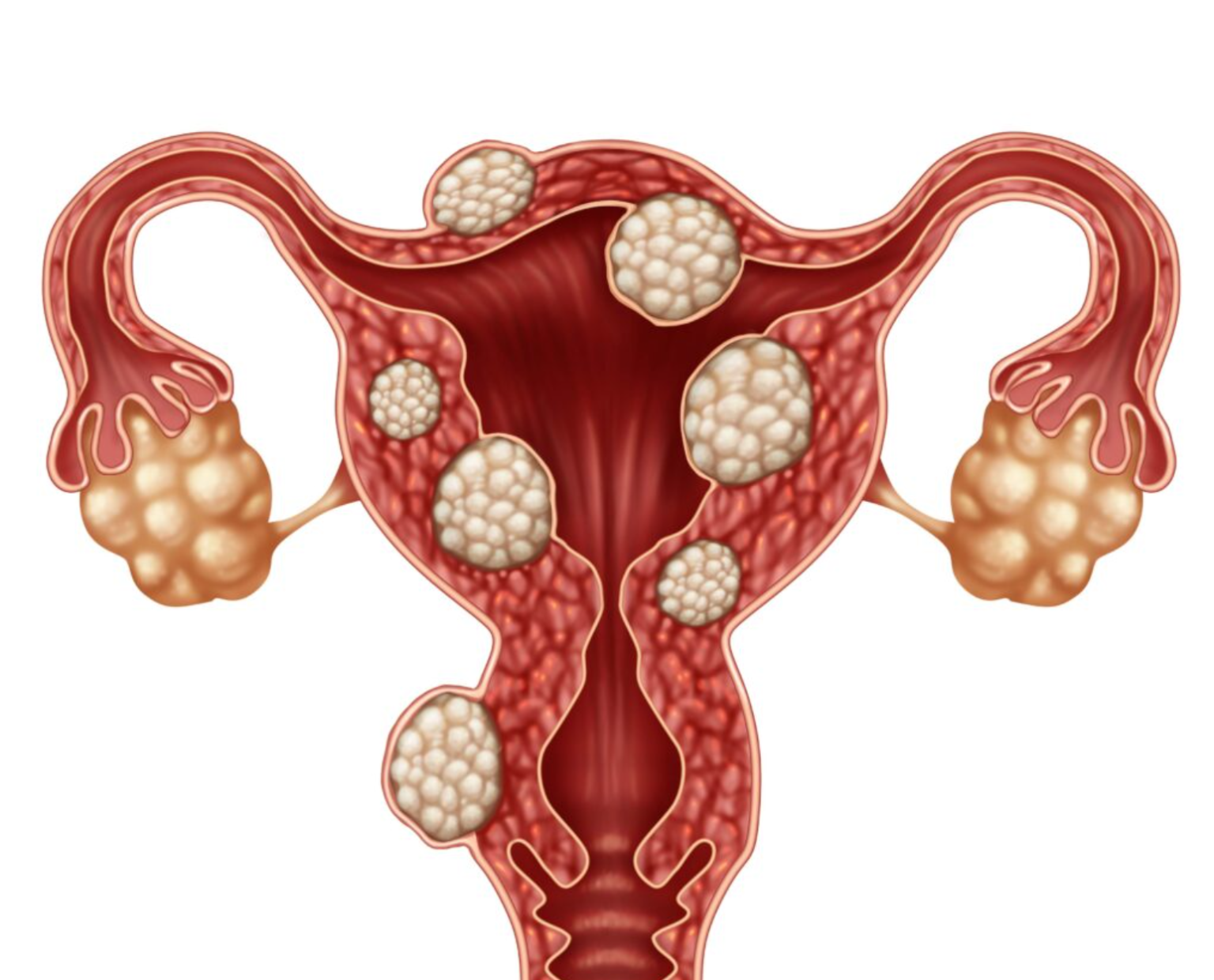 Uterine Fibroid Embolisation: A minimally invasive way to treat fibroids without surgery