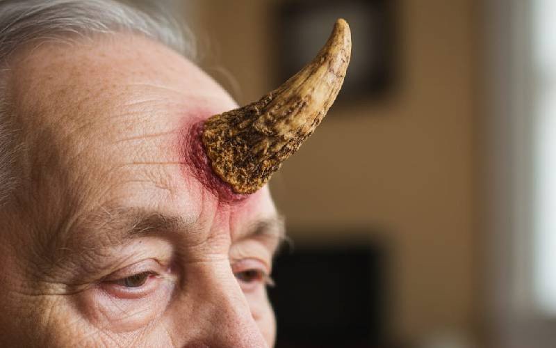 Why some humans grow horns Why some humans grow horns